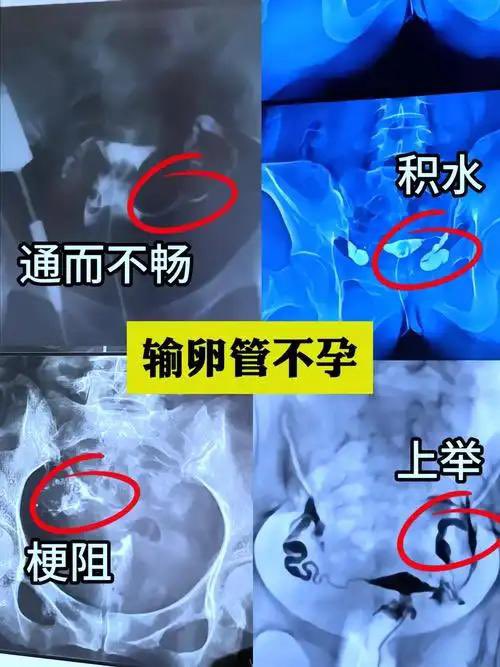 jiabaoivf's tweet photo. 嘉宝健康：那些关于输卵管造影检查的小tips

输卵管造影就是向子宫腔内注入造影剂后，在X线或超声下观察宫腔输卵管显影的形态、输卵管伞端开放情况及输卵管畅通程度，从而判断子宫有无畸形、输卵管有无阻塞以及阻塞的位置。
做输卵管检查的时间是女性月经干净的3~4天且无性生活，并需要配合医生做一些术前化验。
例如当月的尿妊娠以及阴道分泌物查，半年内的血常规、肝炎、梅毒、艾滋等。
同时医生会为您做妇科检查。无异常后可以去放射科进行预约。
做造影时最好带家属陪护。
输卵管造影检查后两周之内应禁止盆浴和性生活，以免引发感染。
术后遵医嘱用药，口服抗生素3~5天，预防感染。
输卵管造影检查后一周内有少量的阴道出血属于正常现象，如果出血量超过平时的月经量或者有持续性加重的腹痛，则需要到医院进行相关复查。