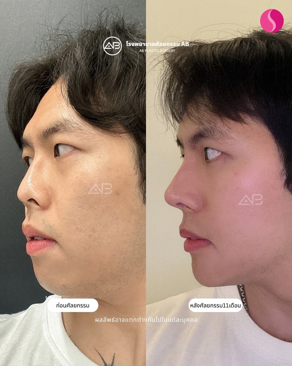 stmstyle_'s tweet photo. ศัลยกรรมแค่จมูก แต่ก็ได้ลุคที่เปลี่ยนแบบ พลิกก!!!
ศัลยกรรมจมูกคุณผู้ชายที่เอบี 🩵

ปรึกษาฟรี! Line Official: https://t.co/z0nCYcwy5u 

#เสริมจมูก #ทำจมูก #จมูกผู้ชาย #ศัลยกรรม #รีวิวศัลยกรรม https://t.co/sUH5rExQia