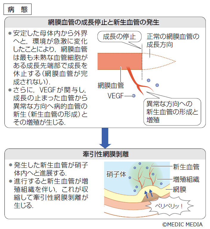 未熟児網膜症】未熟児網膜症は網膜血管が未熟な早産児や低出生体重児の