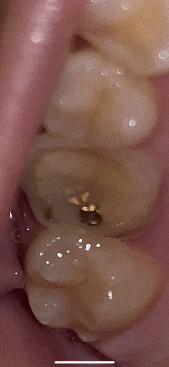 根幹治療して今土台の段階なんですけど、めちゃくちゃズキズキするの何でですか？（；＿；）
あとこのキラキラしたのは何ですか？？