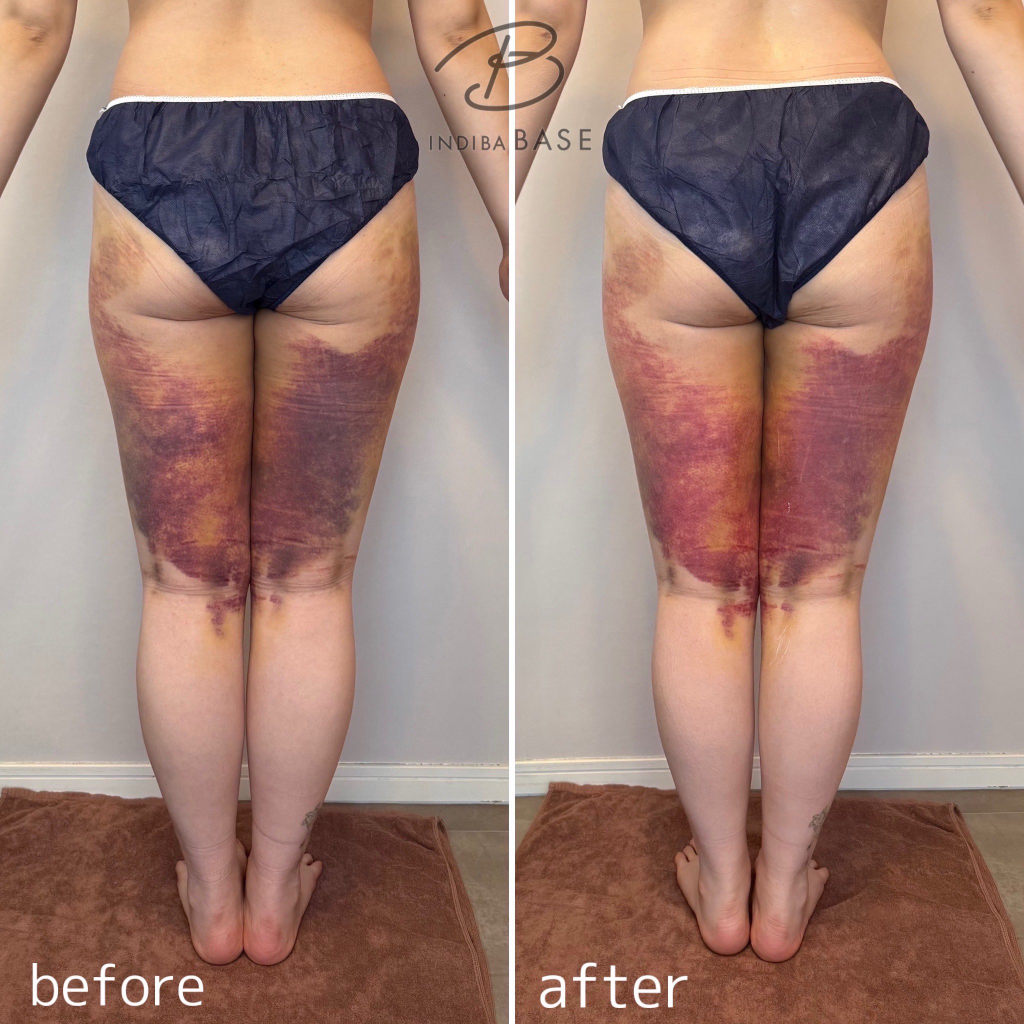 インディバ専門店INDIBA BASE (@indiba_base) / X