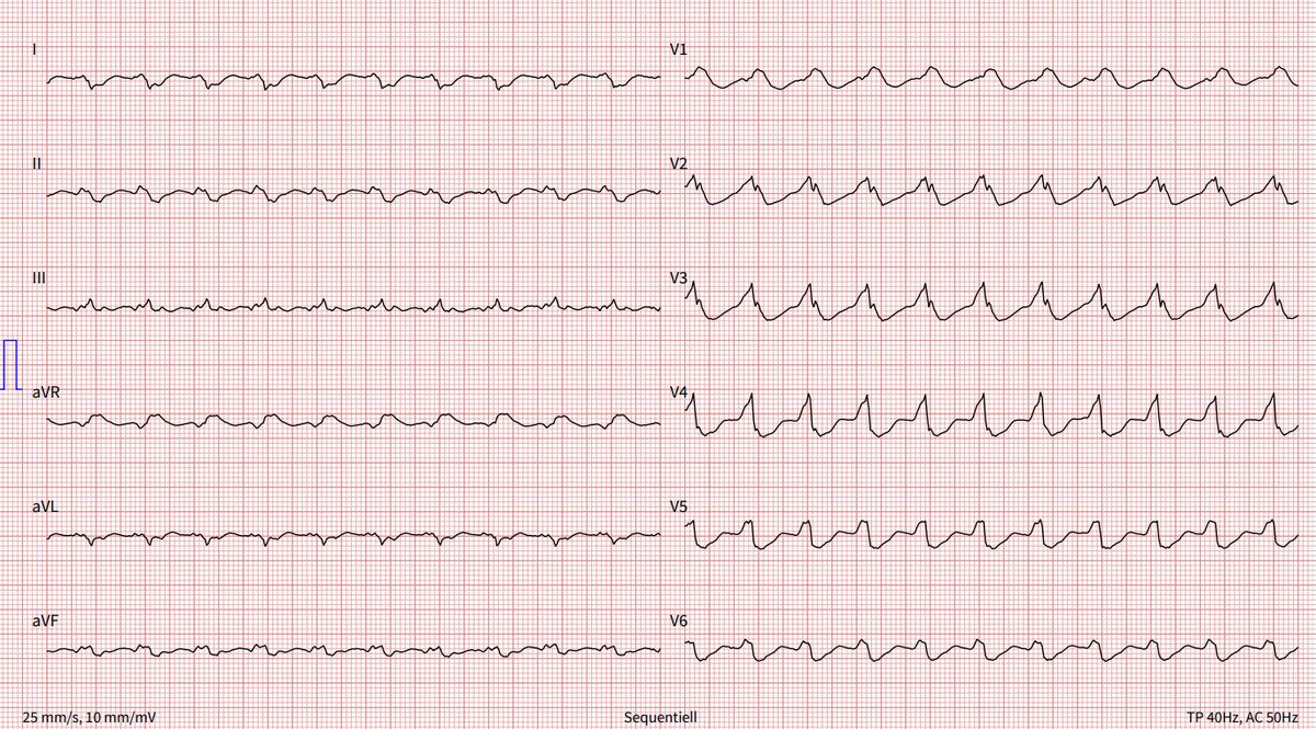 Lorin Braschler, MD (@cardiodevotee) on Twitter photo 66yo male
Palpitations
Non-ischemic DCM, LVEF 30%
CRT-D implantation with history of electrical storm
Rhythm?
<a href="/ecgandrhythmRoe/">Dr. Andreas Roeschl</a>
<a href="/EcgOxford/">đ«EcgOxford</a>
<a href="/DrRazi4/">Dr Razi</a>
<a href="/PendellM/">Pendell Meyers</a>
<a href="/RobertHermanMD/">Robert Herman, MD, PhD</a>
<a href="/Arron_Pearce_/">Arron Pearce</a>
<a href="/ECGwithReid/">ECG Reid</a>
<a href="/EM_Resus/">Sam Ghali, M.D.</a>
@PMcardioBot
#ECG #CardioTwitter #MedTwitter #MedX 66yo male
Palpitations
Non-ischemic DCM, LVEF 30%
CRT-D implantation with history of electrical storm
Rhythm?
<a href="/ecgandrhythmRoe/">Dr. Andreas Roeschl</a>
<a href="/EcgOxford/">đ«EcgOxford</a>
<a href="/DrRazi4/">Dr Razi</a>
<a href="/PendellM/">Pendell Meyers</a>
<a href="/RobertHermanMD/">Robert Herman, MD, PhD</a>
<a href="/Arron_Pearce_/">Arron Pearce</a>
<a href="/ECGwithReid/">ECG Reid</a>
<a href="/EM_Resus/">Sam Ghali, M.D.</a>
@PMcardioBot
#ECG #CardioTwitter #MedTwitter #MedX