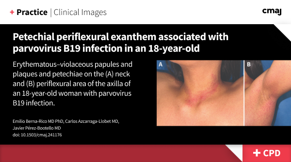Parvovirus B19 infection:
While uncommon in adults, people with parvovirus B19 infection often present with fever, rash, headache, lymphadenopathy, and symmetric joint pain in the phalanges, wrists, ankles, elbows, and knees.
➡️ cmaj.ca/lookup/doi/10.…
(earn CPD credits)