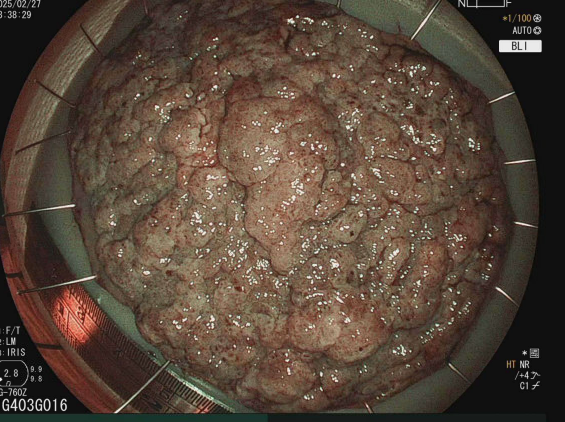 Daryl Ramai, MD, MPH, MSc. (@darylramai) on Twitter photo Incredibly grateful 🙏to have dedicated Third Space Endo training under the mentorship of <a href="/ThirdspaceEndo/">Hiroyuki Aihara, MD, PhD</a>.
Today marked a pivotal moment in my training by doing a solo 9⃣ cm 70% circumferential ESD at 2⃣ hours. Patient did excellent post-op. Incredibly grateful 🙏to have dedicated Third Space Endo training under the mentorship of <a href="/ThirdspaceEndo/">Hiroyuki Aihara, MD, PhD</a>.
Today marked a pivotal moment in my training by doing a solo 9⃣ cm 70% circumferential ESD at 2⃣ hours. Patient did excellent post-op.