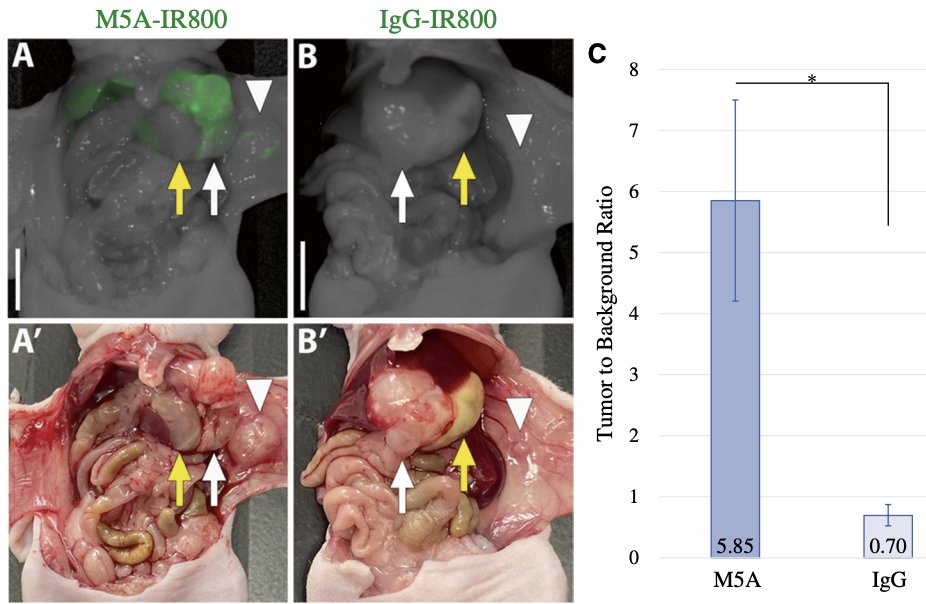 Annals of Surgical Oncology (@annsurgoncol) on Twitter photo Featured: Targeting Patient-Derived Orthotopic #GastricCancers with a Fluorescent Humanized Anti-CEA Antibody
ow.ly/KtWf50V6uHo
<a href="/AradhyaNigamMD/">Aradhya Nigam, MD</a>
<a href="/SyedAAhmad5/">Syed A. Ahmad</a> Featured: Targeting Patient-Derived Orthotopic #GastricCancers with a Fluorescent Humanized Anti-CEA Antibody
ow.ly/KtWf50V6uHo
<a href="/AradhyaNigamMD/">Aradhya Nigam, MD</a>
<a href="/SyedAAhmad5/">Syed A. Ahmad</a>