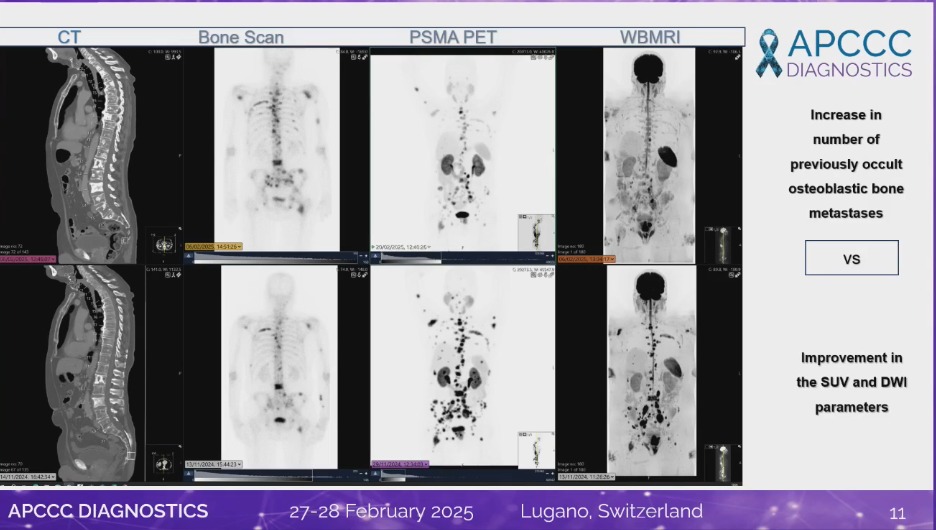 nataliagandur's tweet photo. ππ΄ LIVE from #APCCC25! #APCCCDiagnostics25
π’ When to assess biology with ctDNA?
π Crystal-clear explanation by @ResearchWyatt on the role of ctDNA in dynamic tumor assessment and treatment decisions!
@APCCC_Lugano @OncoAlert
π‘ Key takeaways:
β
Early ctDNA clearance predicts better outcomes compared to PSA alone.
β
ctDNA as a response biomarker is being integrated into RECIST guidelines.
β
Challenges remain: standardization, biological confounders, and optimal timing.
β
Next steps: refining thresholds, simplifying assays, and designing trials to validate interventions.
@ProfKHerrmann @stefanofanti4 @Silke_Gillessen @AOmlin @Albert0Briganti @Ecastromarcos @drlouiseemmett @DrAGafita @karolien_goffin @ProfHadaschik @DrMHofman @Prof_Nick_James @piet_ost @gpalapa2 @MoniqueRoobol @TylerSbrt @DrSpratticus @Tilki_De @BertrandTOMBAL @Nina18205 @UrsulaVogl @ResearchWyatt