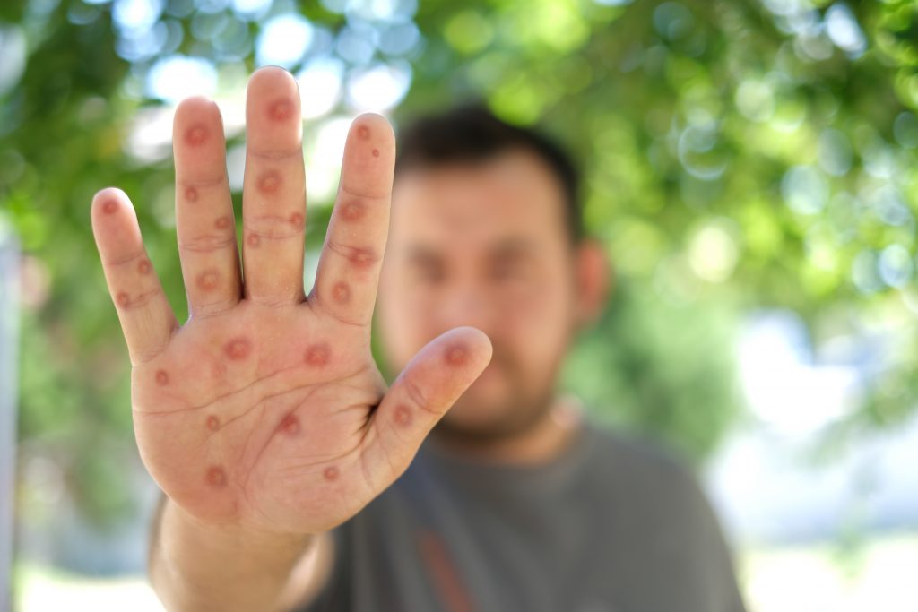 MEDIA STATEMENT | Health Department calls for vigilance as three new mpox cases are detected

The Department of Health urges the public to remain vigilant as the country confirms three new laboratory-confirmed cases of mpox, bringing the total cumulative number of positive ...