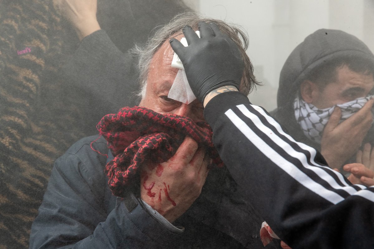 lolosmarios's tweet image. Ο συνάδελφος Ορέστης Παναγιώτου τραυματισμένος από κρότου λάμψης στο κεφάλι. Βγαίνει από το νοσοκομείο με μειωμένη ακοή αφού τον έραψαν πρώτα.