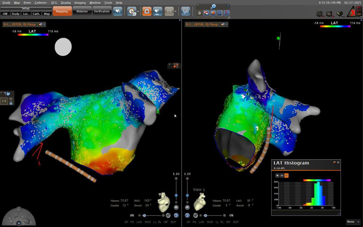 Prof Dhiraj Gupta (@dhirajguptabhrs) on Twitter photo Case 2: epicardial atrial mapping after PVI and CTI in HOCM AF and Flutter.
Thanks <a href="/vish_luther/">Dr Vishal Luther</a> and <a href="/JohnSilberbauer/">John Silberbauer</a> for the amazing technique of CS CO2 insufflation Case 2: epicardial atrial mapping after PVI and CTI in HOCM AF and Flutter.
Thanks <a href="/vish_luther/">Dr Vishal Luther</a> and <a href="/JohnSilberbauer/">John Silberbauer</a> for the amazing technique of CS CO2 insufflation