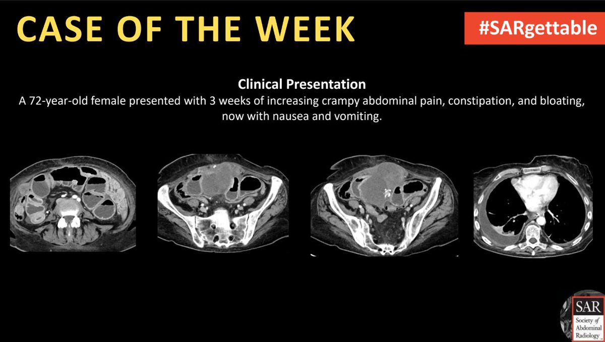 Society of Abdominal Radiology | SAR (@societyabdrad) on Twitter photo It's time for a new #SARgettable case of the week contributed by <a href="/ErinCookeMD/">Erin Cooke, MD</a>. Comment with your diagnosis down below! It's time for a new #SARgettable case of the week contributed by <a href="/ErinCookeMD/">Erin Cooke, MD</a>. Comment with your diagnosis down below!