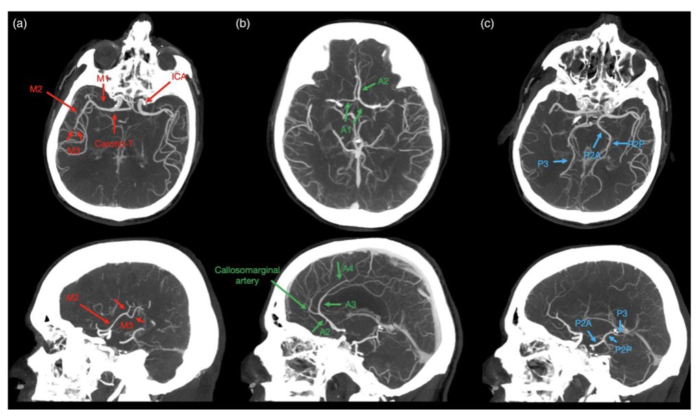 Johanna Ospel, MD PhD tweet media
