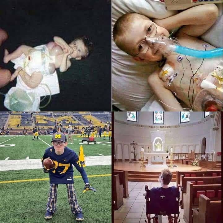 Today is rare disease day. I was born with spina bifida, massive omphalocele, cloacal extrophy, club feet, mild cerebral palsy, short gut syndrome and much more. I have no bladder or colon. I survived testicular cancer at age 14. I've had kidney stones as big as pool table balls.