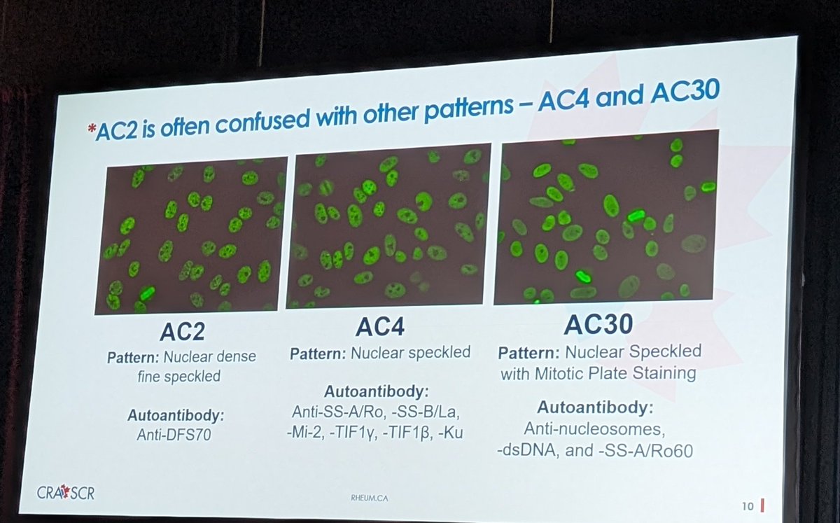 Be careful of ruling out a systemic rheumatic disease based on a DFS pattern on ANA! 
This pattern can be confused with other patterns 

#rheumatology #CRA2025 <a href="/CRASCRRheum/">CRA SCR</a> <a href="/maychoi_lab/">maychoi</a>