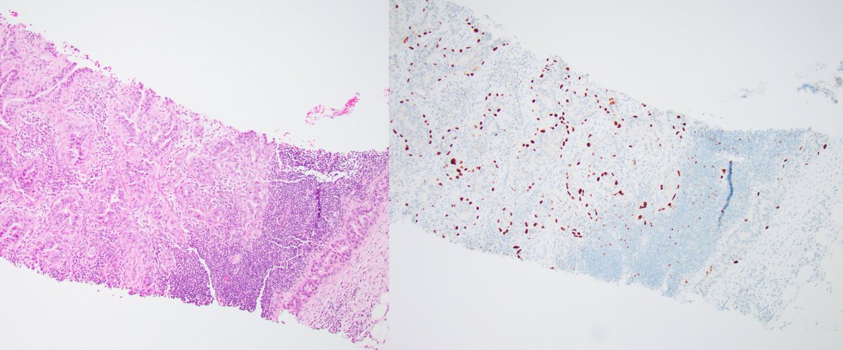 Fouad Boulos (@fouad_boulos) on Twitter photo Pitfalls of p63: Case 5
This one is for the history books.
What is your diagnosis?
Again, diagnosis and explanation for both today's and yesterday's cases on Monday.
Have a great weekend and see you next week!
<a href="/washu_pathology/">WashU Medicine Pathology & Immunology</a> <a href="/washupathedu/">WashU Medicine Pathology & Immunology Education</a> #breastpath #PathTwitter #PathX Pitfalls of p63: Case 5
This one is for the history books.
What is your diagnosis?
Again, diagnosis and explanation for both today's and yesterday's cases on Monday.
Have a great weekend and see you next week!
<a href="/washu_pathology/">WashU Medicine Pathology & Immunology</a> <a href="/washupathedu/">WashU Medicine Pathology & Immunology Education</a> #breastpath #PathTwitter #PathX