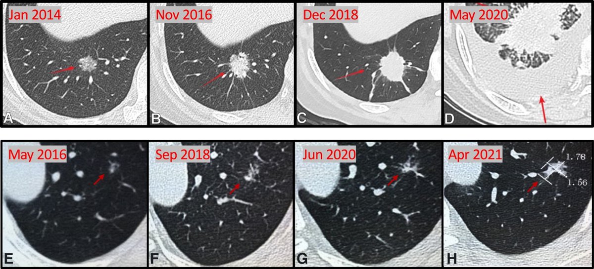 AATS (@aatshq) on Twitter photo How has #NSCLC treatment evolved over the past few decades? Researchers say there has been a shift in the surgical paradigm to a more individualized approach. As an Editor's Choice article, you can read this for free until 3/30: doi.org/10.1016/j.jtcv… How has #NSCLC treatment evolved over the past few decades? Researchers say there has been a shift in the surgical paradigm to a more individualized approach. As an Editor's Choice article, you can read this for free until 3/30: doi.org/10.1016/j.jtcv…