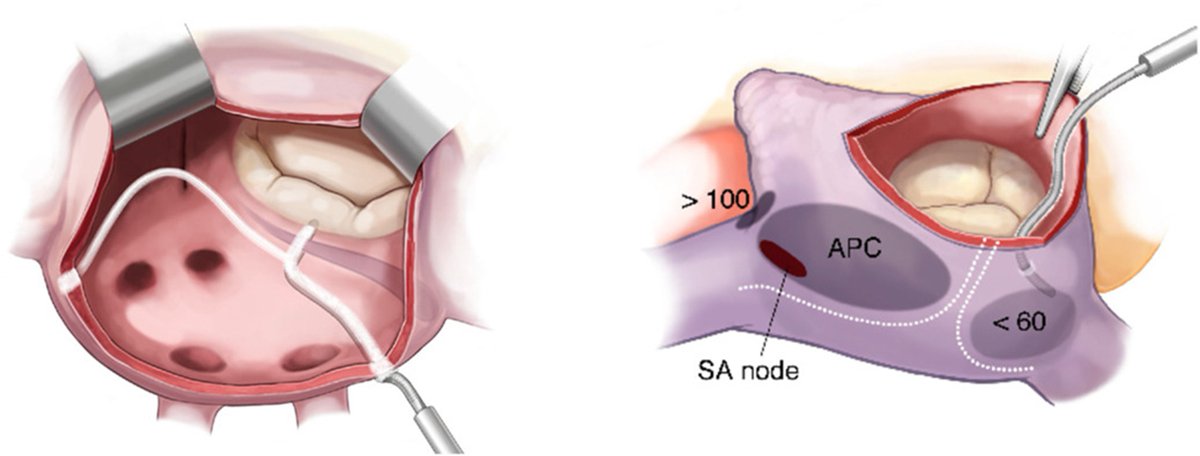 AATS (@aatshq) on Twitter photo Patrick McCarthy & James Cox at <a href="/NUFeinbergMed/">Northwestern Feinberg School of Medicine</a> published an Invited Expert Review explaining practical approaches to concomitant surgical ablation of atrial fibrillation. As an Editor's Choice article, this is free to view until 3/30. Read in #JTCVS: doi.org/10.1016/j.jtcv⦠Patrick McCarthy & James Cox at <a href="/NUFeinbergMed/">Northwestern Feinberg School of Medicine</a> published an Invited Expert Review explaining practical approaches to concomitant surgical ablation of atrial fibrillation. As an Editor's Choice article, this is free to view until 3/30. Read in #JTCVS: doi.org/10.1016/j.jtcvā¦
