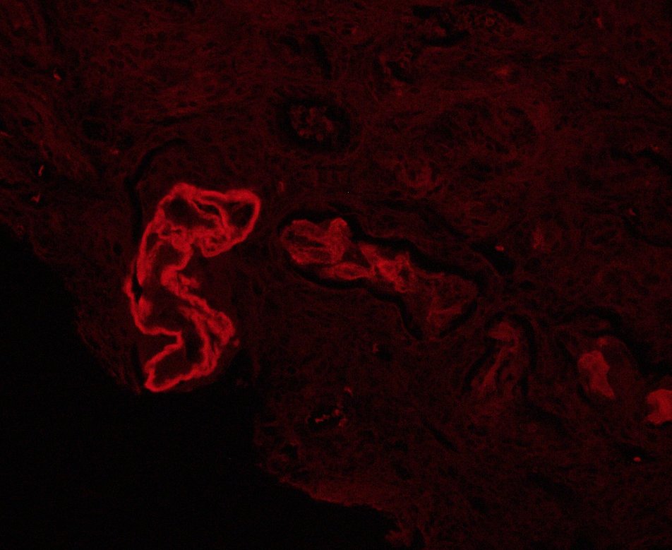 Striking example of light chain cast nephropathy with intra-tubular amyloid phenotype in an MM pt. PAS pale atypical casts with cellular reaction. Fuzzy periphery with spicules and + congo red. #renalpath #nephrology #PathTwitter