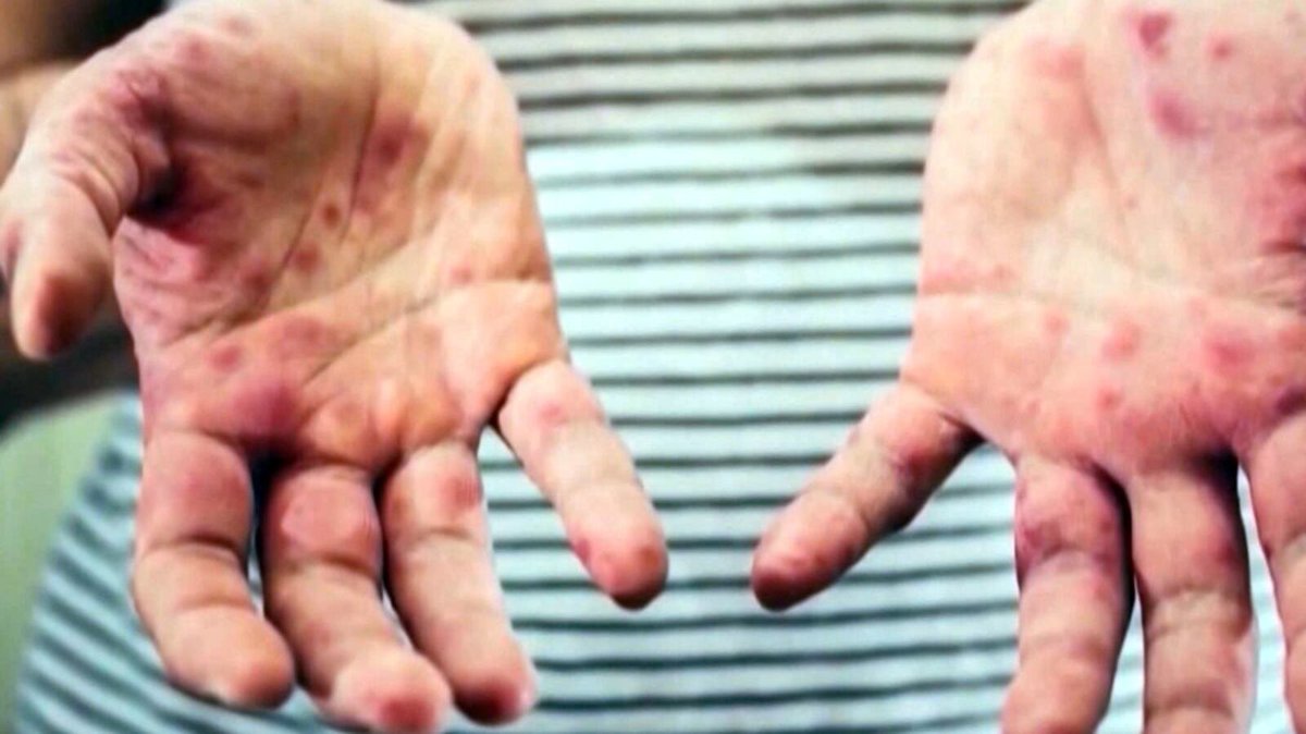 Confirmed measles case linked to international flight that landed at Toronto Pearson: health unit
cp24.com/news/2025/02/2…