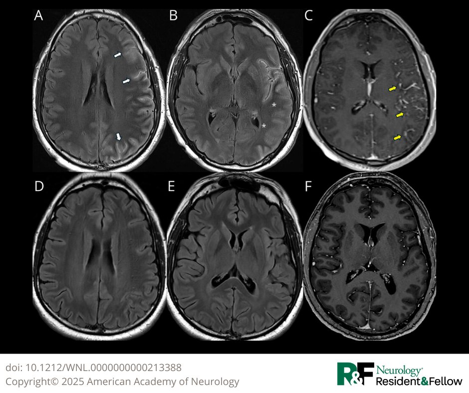 Teaching NeuroImage: A Case of GFAP and MOGAD Overlap Encephalitis Mimicking Infectious Meningoencephalitis
hubs.la/Q038H8qs0

#NeurologyRF