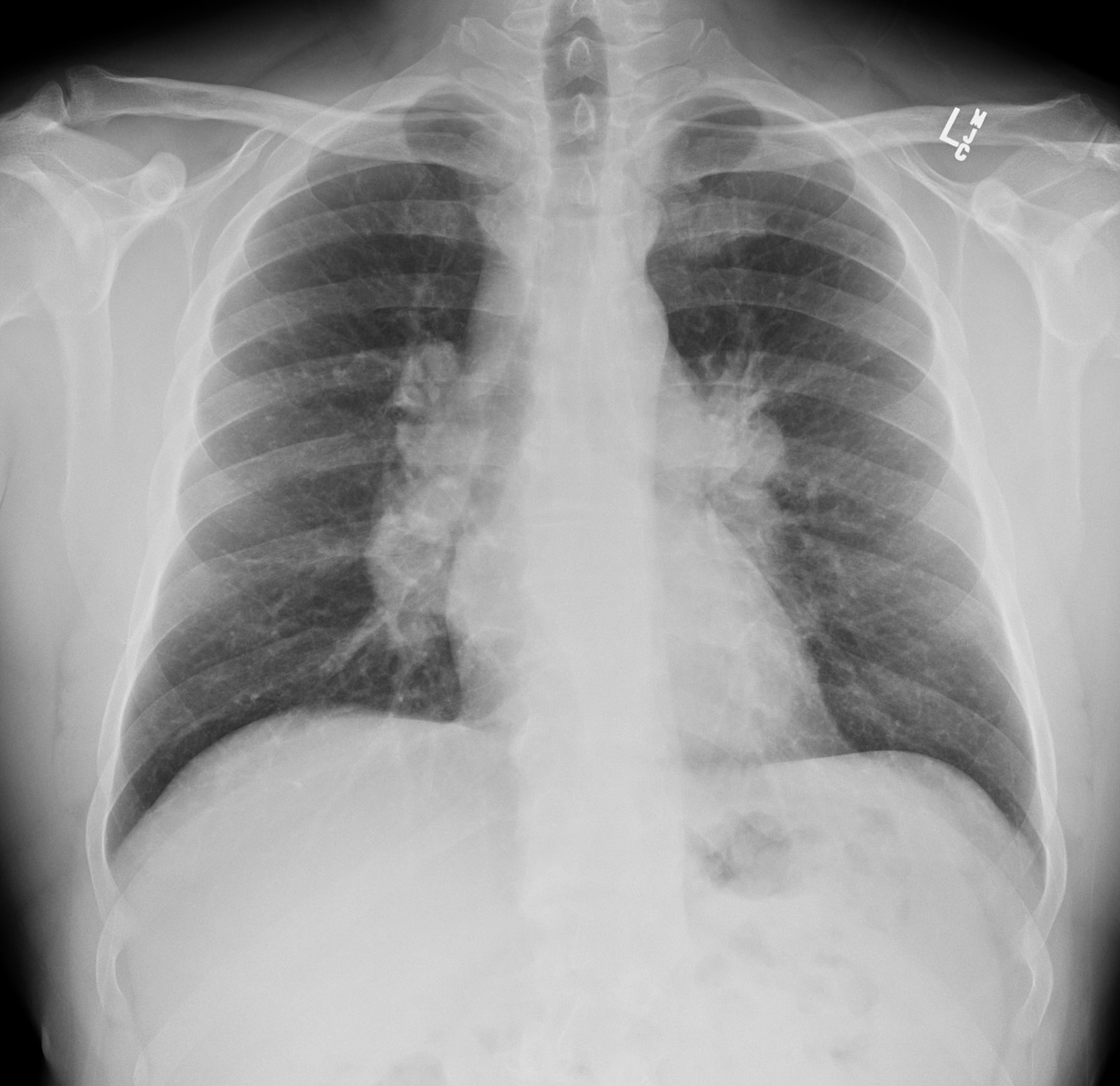 LITFL (@litflblog) on Twitter photo What abnormalities do you see?
By the way: Chest X-ray Essentials course over at <a href="/medmastery/">Medmastery</a> is still free until May 19th -> medmastery.com/workshops/ches…
#FOAMed #MedEd #MedTwitter #Radiology #ChestXray What abnormalities do you see?
By the way: Chest X-ray Essentials course over at <a href="/medmastery/">Medmastery</a> is still free until May 19th -> medmastery.com/workshops/ches…
#FOAMed #MedEd #MedTwitter #Radiology #ChestXray