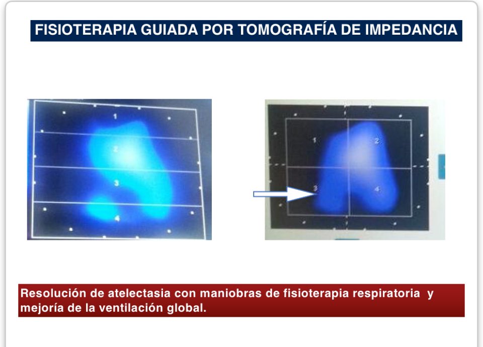Visualizando el efecto de terapia respiratoria