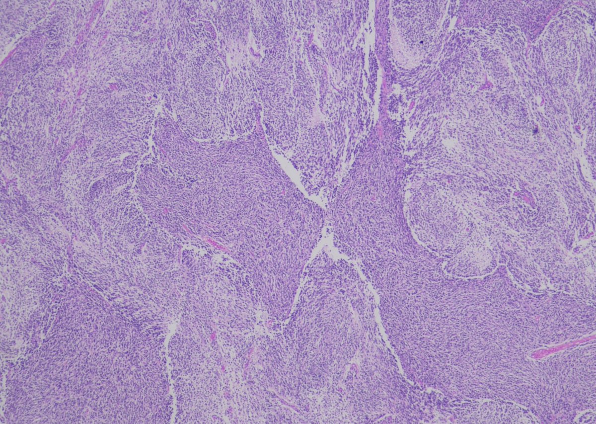 nandinipath's tweet image. 2/Fch Posterior fossa SOL @Gowri_passionP @ashokparameswar @atman_ci @TristanRutland7  #CNSpath More pictures in the thread
