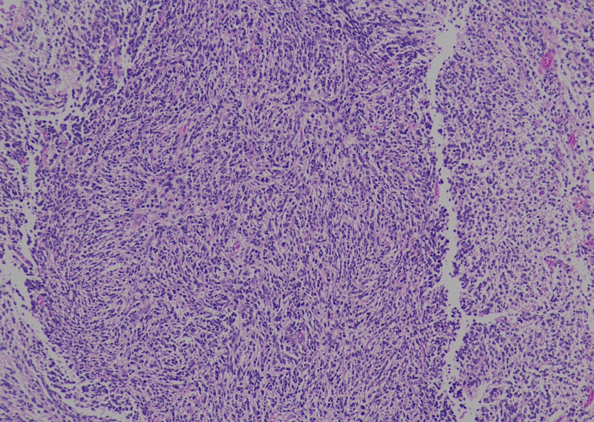 nandinipath's tweet image. 2/Fch Posterior fossa SOL @Gowri_passionP @ashokparameswar @atman_ci @TristanRutland7  #CNSpath More pictures in the thread