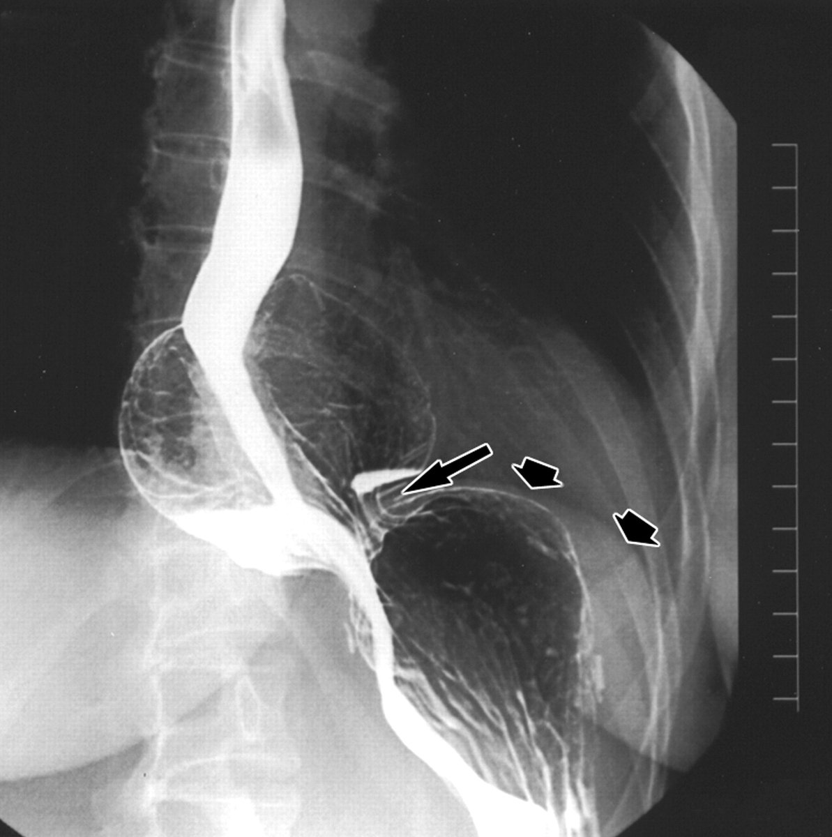 almagoch's tweet image. La migración transhiatal de una #funduplicatura debe considerarse una #urgencia. 
Puede suceder por: la disrupción de la funduplicatura (22.7%), telescoping (14.1%), una #hernia paraesofágica (6.1%), o por la disrupción del #hiato (5.3%). #Cirugía #Cirujanos