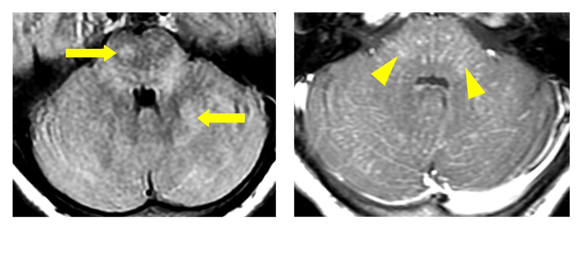 CLIPPERS should prompt neurologists to consider genes associated with familial hemophagocytic lymphohistiocytosis (HLH).

 <a href="/UCCMedHealth/">UCC Medicine & Health</a>   <a href="/DrRebeccaboyd/">Rebecca Boyd</a>