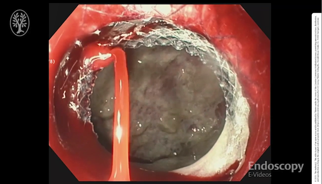 Erik Holzwanger, MD, ABOM-D (@hilarholzy) on Twitter photo 🔥Ever run into 🩸 issues with LAMS deployment❓👀 <a href="/endoscopyjrnl/">Endoscopy Journal</a> below on how we stopped arterial bleeding after dilation of LAMS
💡Embolization may not always be needed
pmc.ncbi.nlm.nih.gov/articles/PMC11…
#GITwitter <a href="/butrosfakhoury/">Butros Fakhoury</a> <a href="/MikeTalanian/">Michael Talanian</a> <a href="/ErikaTsuchiyose/">Erika Tsuchiyose</a> <a href="/tanya_zeina/">Tanya Zeina, MD</a> <a href="/AwadallaMD/">Mohanad Awadalla</a> 🔥Ever run into 🩸 issues with LAMS deployment❓👀 <a href="/endoscopyjrnl/">Endoscopy Journal</a> below on how we stopped arterial bleeding after dilation of LAMS
💡Embolization may not always be needed
pmc.ncbi.nlm.nih.gov/articles/PMC11…
#GITwitter <a href="/butrosfakhoury/">Butros Fakhoury</a> <a href="/MikeTalanian/">Michael Talanian</a> <a href="/ErikaTsuchiyose/">Erika Tsuchiyose</a> <a href="/tanya_zeina/">Tanya Zeina, MD</a> <a href="/AwadallaMD/">Mohanad Awadalla</a>