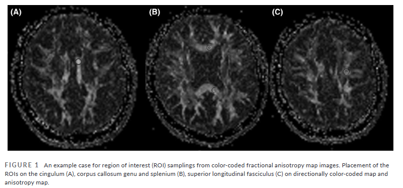 HeadacheJournal's tweet image. #DiffusionTensorImaging reveals microstructural changes in brain white matter that can occur in the setting of #SpontaneousIntracranialHypotension
…adachejournal.onlinelibrary.wiley.com/doi/full/10.11…
Serdar Balsak MD et al