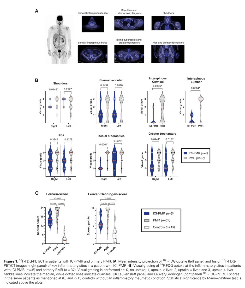 alb_giraldo's tweet photo. Although most of the clinical and ultrasonographic findings are comparable in both immune #checkpoint inhibitor-mediated #polymyalgia #rheumatica (ICI-PMR) and primary PMR, laboratory and 18F-FDG-PET/CT assessments suggest that ICI-PMR is associated with less intense #inflammation than primary PMR. Therefore, ICI-PMR can be managed with lower glucocorticoid doses than the primary PMR group, while this treatment could be discontinued more quickly. These findings indicate that ICI-PMR is a PMR-like syndrome rather than a true form of primary PMR.
*Vermeulen OCB, Brouwer E, Slart RHJA, et al. Immune checkpoint inhibitor-mediated polymyalgia rheumatica versus primary polymyalgia rheumatica: comparison of disease characteristics and treatment requirement. Rheumatology (Oxford). 2025;64(2):771-779.
๐https://t.co/jtxujYtsAr