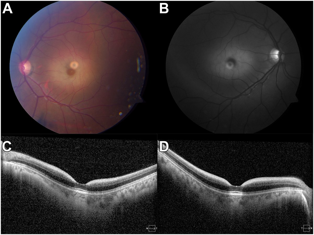 Ocular Type 1 Sialidosis
ow.ly/Ksck50UHENb
#ophthalmology #retina