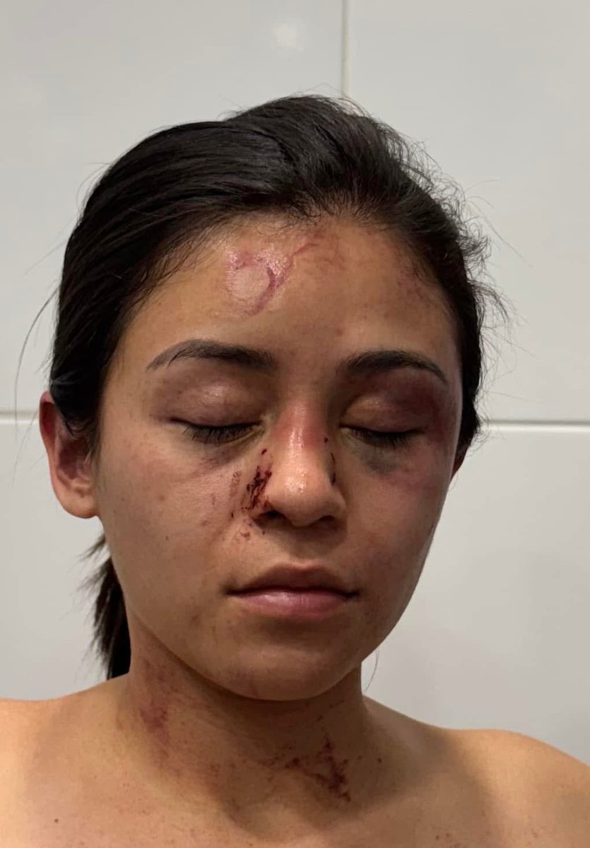 LaChonnaCuerera's tweet photo. #TentativaDeFeminicidio 
#DerechosHumanos 

El día 15 de Febrero a las 6:00 am, mi novio quien responde al nombre de RUBI N de nacionalidad indu-italiana,dentro de su departamento ubicado en la calle de Homero,en Polanco en la Alcaldía Miguel Hidalgo, en la CDMX, me agredió brutalmente de forma física por casi una hora, con la intención de privarme de mi vida, cometido que no logró debido a que policías de la SSC de la Ciudad de México intervino gracias a que el personal de seguridad del edificio les permitieron el acceso ya que escucharon de mis gritos de auxilio 
• Ayer mismo (15 de febrero) se inició la carpeta de investigación correspondiente ante el Agente del Ministerio Público en la alcaldía Miguel Hidalgo en la coordinación territorial MH-5, sin embargo, el ministerio público a pesar de que se le pidió que iniciara la carpeta por Feminicidio en grado de tentativa. De manera unilateral y de manera arbitraria, la inició por #VIOLENCIA #FAMILIAR, lo que le da la posibilidad al agresor de obtener su libertad a través de una suspensión condicional
Remitieron la carpeta de investigación a la fiscalía especializada en violencia familiar ubicada en el búnker, lugar donde el agente del ministerio público no quería recibir un escrito de mi persona donde en una ampliación de denuncia se solicita que se reclasifique el delito como tentativa de feminicidio 

-Los hechos fueron debido a que un día antes (14 de febrero) nos fuimos a festejar a un restaurante y a un antro en Polanco y al llegar al domicilio de mi pareja el cual estaba en total estado de ebriedad y bajo influencia de drogas me comenzó a violentar física y psicológicamente (me comenzó a asfixiar y a golpear, humillándome y amenazandome de muerte ) lo que no logró por la intervención de la policía.

Deseo que se realice justicia por parte de las autoridades y que no haya corrupción en el medio de esta situación para que no vuelvan a suceder este tipo de actos injustificables. 

Nada justifica la violencia,la sentencia debe de ser justa!

#tentativadefeminicídio #feminicidio