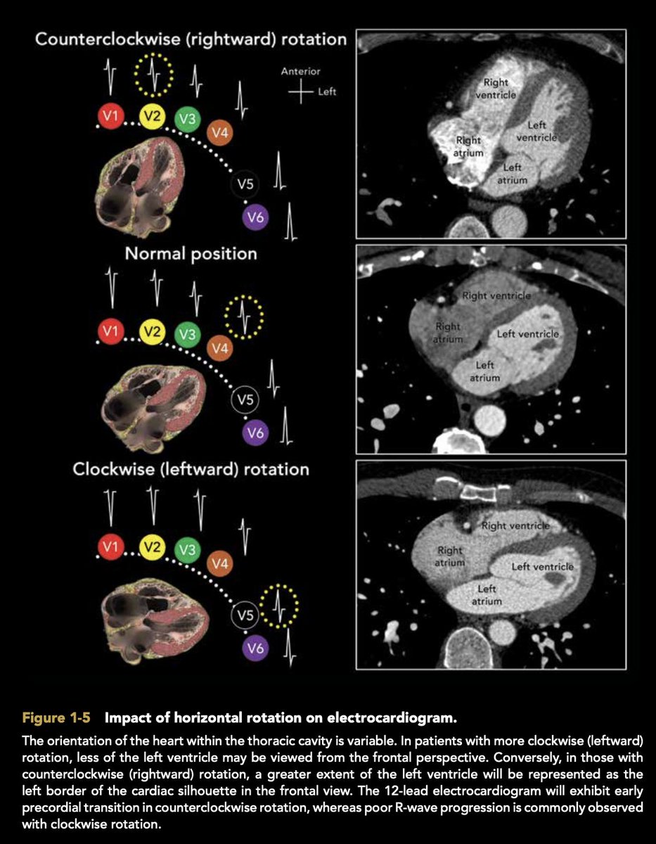 Impact of horizontal rotation on electrocardiogram