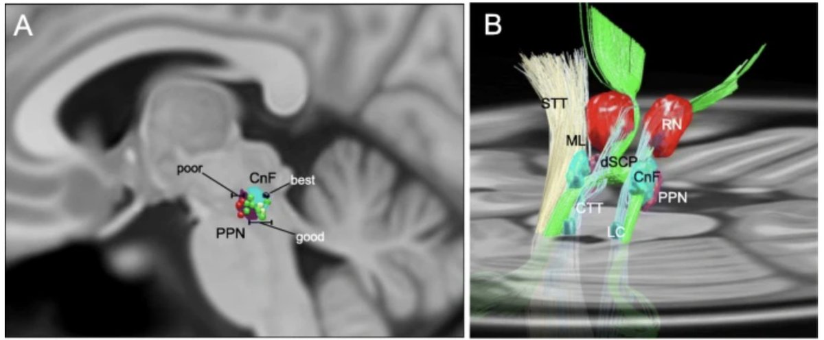 Danny Huang, MD (@yuhaohuangmd) on Twitter photo Fascinating <a href="/ANA_journals/">ANA Journals</a> study inadvertently found that deep brain stimulation of the human midbrain (pedunculopontine nucleus) can induce sleep on-demand. High-frequency stimulation (80Hz) produced NREM sleep within minutes.
pubmed.ncbi.nlm.nih.gov/20437591/
video ⬇️ Fascinating <a href="/ANA_journals/">ANA Journals</a> study inadvertently found that deep brain stimulation of the human midbrain (pedunculopontine nucleus) can induce sleep on-demand. High-frequency stimulation (80Hz) produced NREM sleep within minutes.
pubmed.ncbi.nlm.nih.gov/20437591/
video ⬇️