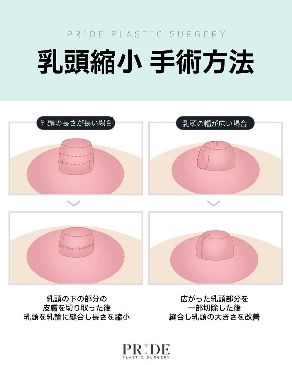 prideseikei's tweet photo. コンプレックスを解消する
￣V￣￣￣￣￣￣￣￣￣￣
💙PRIDE 乳頭縮小💙

乳頭の【高さ】と【幅】の二つを縮小し、乳頭の大きさを平均から平均以下にすることができます🙂

ただいまイベント価格実施中✔✔
ご予約お待ちしております👇🏻

公式LINE🔎https://t.co/STdMR94OFX

#乳頭縮小 #乳頭縮小術 #韓国 #韓国整形 #渡韓 #渡韓整形 #美容整形 #整形垢 #整形垢さんと繋がりたい #整形情報 #韓国整形 #渡韓記録 #韓国クリニック #カウセ #カウセレポ