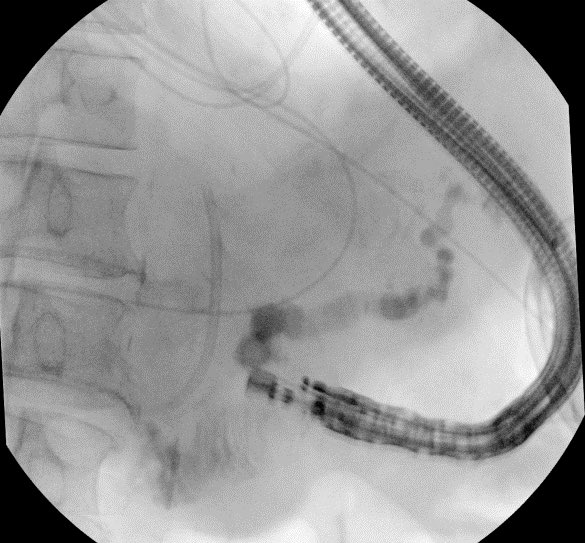 BaystateAdvEndo's tweet photo. A double whammy case of a PD leak post splenectomy for splenic laceration in the setting of a pancreatic head mass prohibiting retrograde PD wire passage. EUS guided pancreaticogastrostomy with placement of a double pigtail stent was performed with resolution of leak. #GITwitter #AdvancedEndoscopy @JohnMil10501740 @kais_zakharia @nha_duongDO