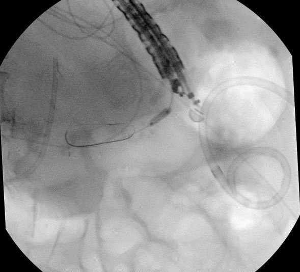 BaystateAdvEndo's tweet photo. A double whammy case of a PD leak post splenectomy for splenic laceration in the setting of a pancreatic head mass prohibiting retrograde PD wire passage. EUS guided pancreaticogastrostomy with placement of a double pigtail stent was performed with resolution of leak. #GITwitter #AdvancedEndoscopy @JohnMil10501740 @kais_zakharia @nha_duongDO