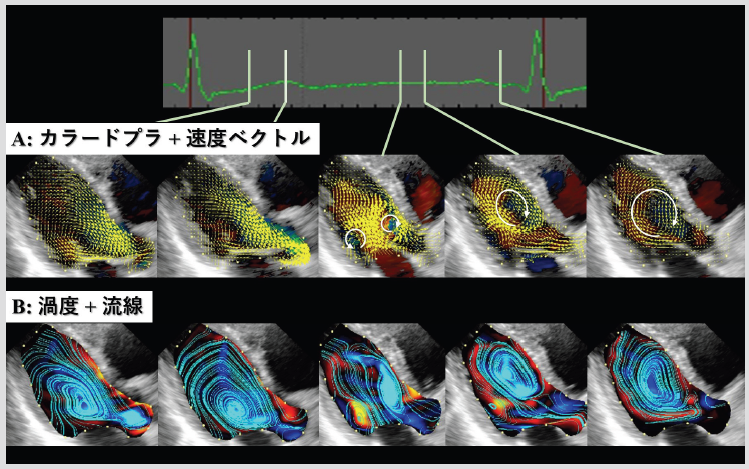 CFD_Inc's tweet photo. この画像は、超音波VFM(vector flow mapping)と呼ばれる心エコーを用いた血流解析に基づく、健常者の左心室の渦流を可視化したものです。
詳しくはこちらをご覧ください:https://t.co/1vzFaQMEUQ
iTEchoにご興味のある方は、info@cfd.lifeまでお気軽にお問い合わせください。 #血流解析 #心臓 https://t.co/IGBD2itt6e