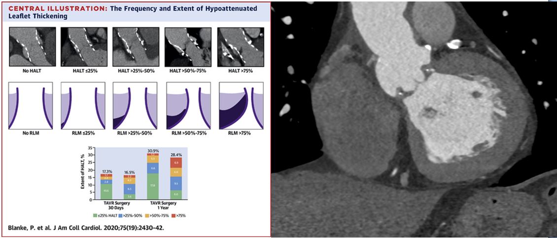 Angelica Maria Romero Daza (@angi_romeromd) on Twitter photo Beautiful HALT (Hypoattenuated Leaflet Thickening) after surgical aortic valve replacement #cardiacimaging #YesCCT #UICAR <a href="/UICARicardiaca/">UICAR Unidad de Imagen Cardiaca</a> Beautiful HALT (Hypoattenuated Leaflet Thickening) after surgical aortic valve replacement #cardiacimaging #YesCCT #UICAR <a href="/UICARicardiaca/">UICAR Unidad de Imagen Cardiaca</a>