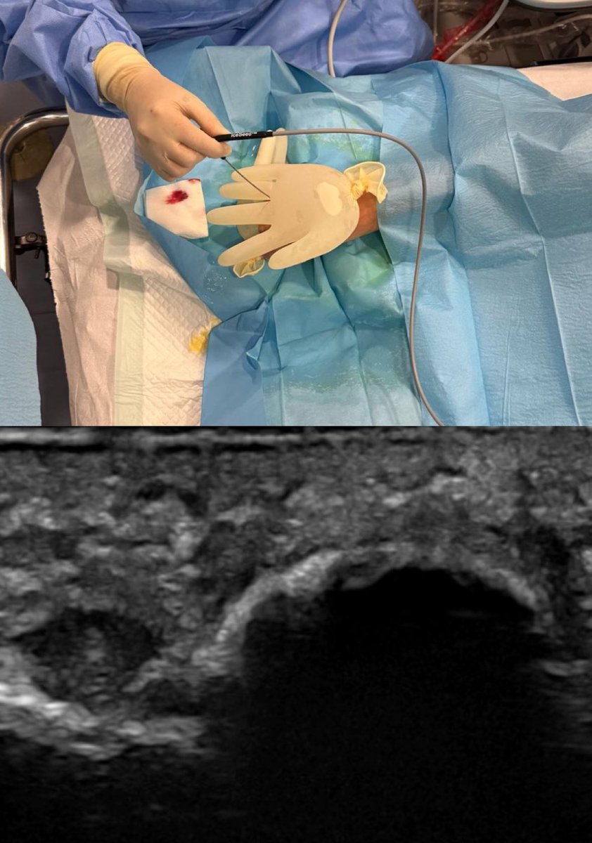 crioablacion ecoguiada de neuroma de morton #ablacionneuroma #somosmarañon #visosalud