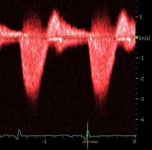 A patient with known cardiomyopathy in ICU, had viral prodrome. BP 81/45 mmHg. Sinus rhythm with narrow QRS. Properly aligned CW interrogation across the mitral valve is shown, what are the findings and hemodynamic implications?