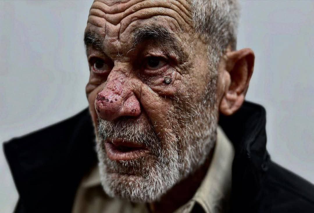 SalihNarin's tweet photo. Direniş anlaşması kapsamında serbest bırakılan Kuzey #Gazzeli yaşlı tutuklu
Galip El-Radi'nin işkenceden vucudandaki etkileri.
Lanetli kaviminden
Nasıl bir işgence gördüklerinin delilidir....
Kahrolsun siyonızm https://t.co/aEWvd6oruq