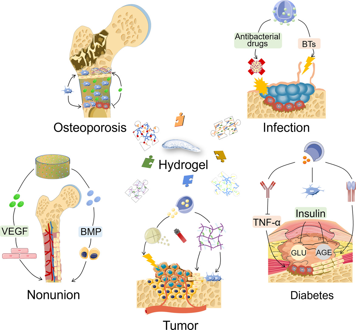 JCRnEDITORS's tweet photo. Bioactive hydrogel formulations for regeneration of pathological bone defects.
| He Liu, Jilin Univ. |
[50 days' free access]
#hydrogel #regeneration #BoneDefect
https://t.co/5cexYXINgo https://t.co/sbFXCL5Oqi