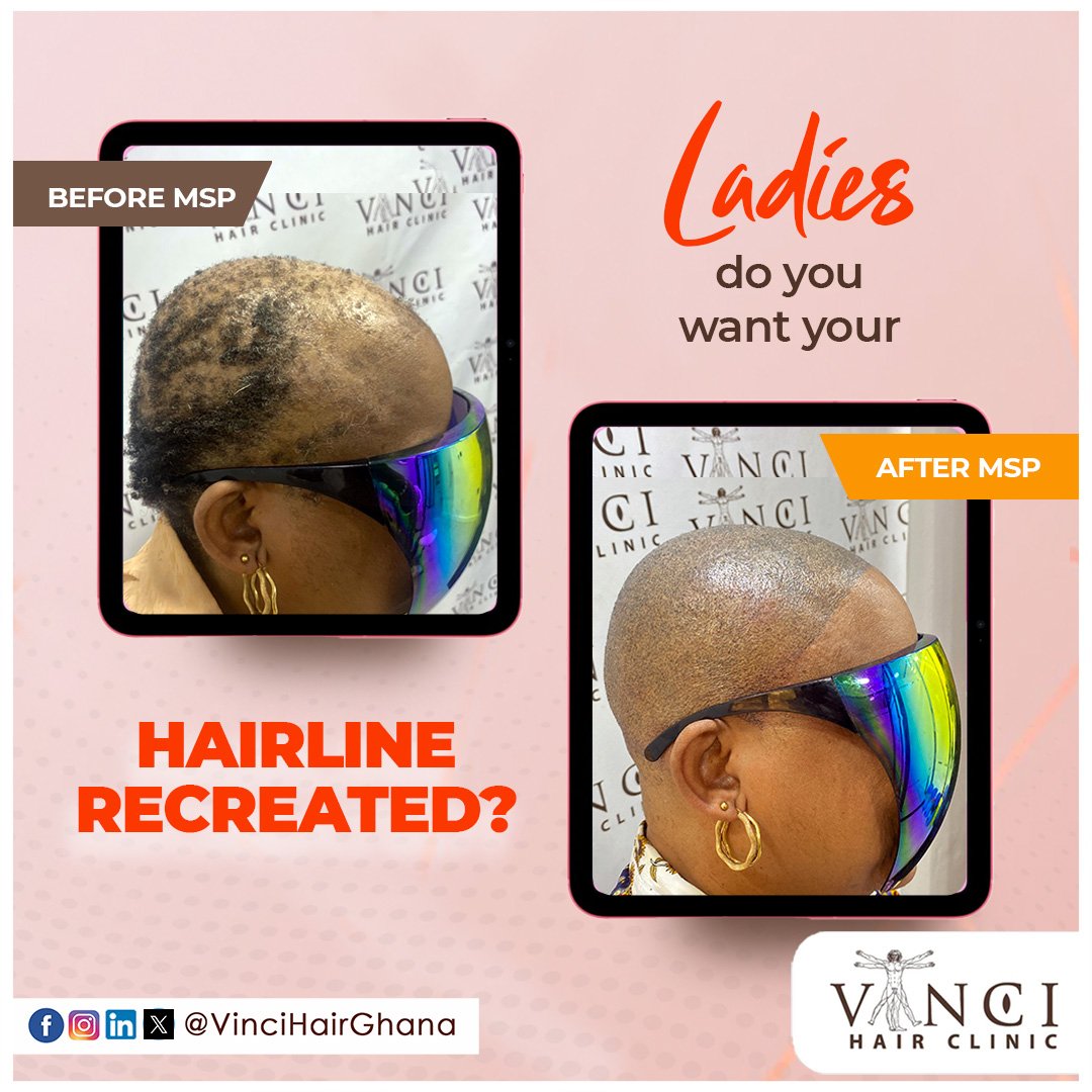 VinciHairGhana's tweet image. Ladies, get a defined hairline with a shaved look in just 3 hours!

An MSP (#MicroScalpPigmentation) could be your solution to extensive hair loss . Book your FREE consultation today at vincihairclinic.africa.
Flexible payment plans available! 
 #HairGoals2025 #VinciHairGhana