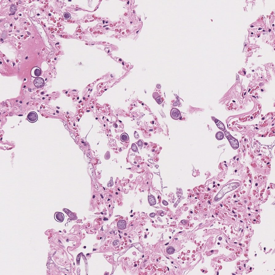 estheryoud's tweet photo. Can anyone help identify these fungi? Blastomycosis??
Lung in an immunocompromised person. 
#pathbugs #crittersontwitter https://t.co/V78hG0kKyj
