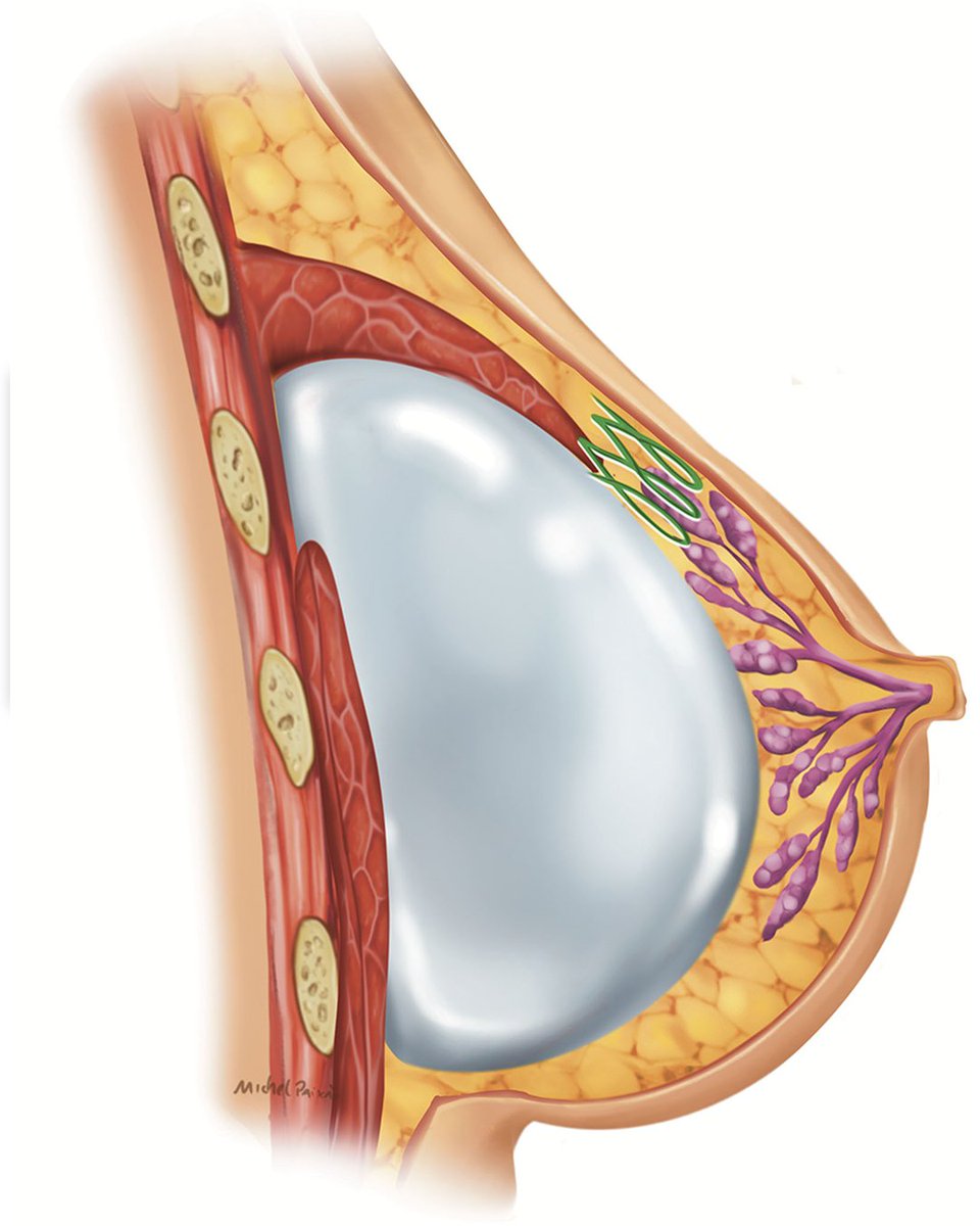 PRSGlobalOpen's tweet image. This #PRSGlobalOpen study aimed to evaluate the effectiveness of an internal #breastlift in correcting #pseudoptosis, grade 1 #breastptosis, and asymmetries, avoiding the creation of an inverted T scar.

📖 Read the full article for FREE here 👉 : l8r.it/yfkW