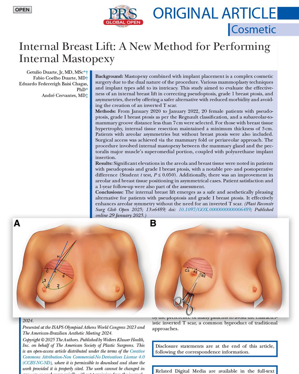 PRSGlobalOpen's tweet image. This #PRSGlobalOpen study aimed to evaluate the effectiveness of an internal #breastlift in correcting #pseudoptosis, grade 1 #breastptosis, and asymmetries, avoiding the creation of an inverted T scar.

📖 Read the full article for FREE here 👉 : l8r.it/yfkW