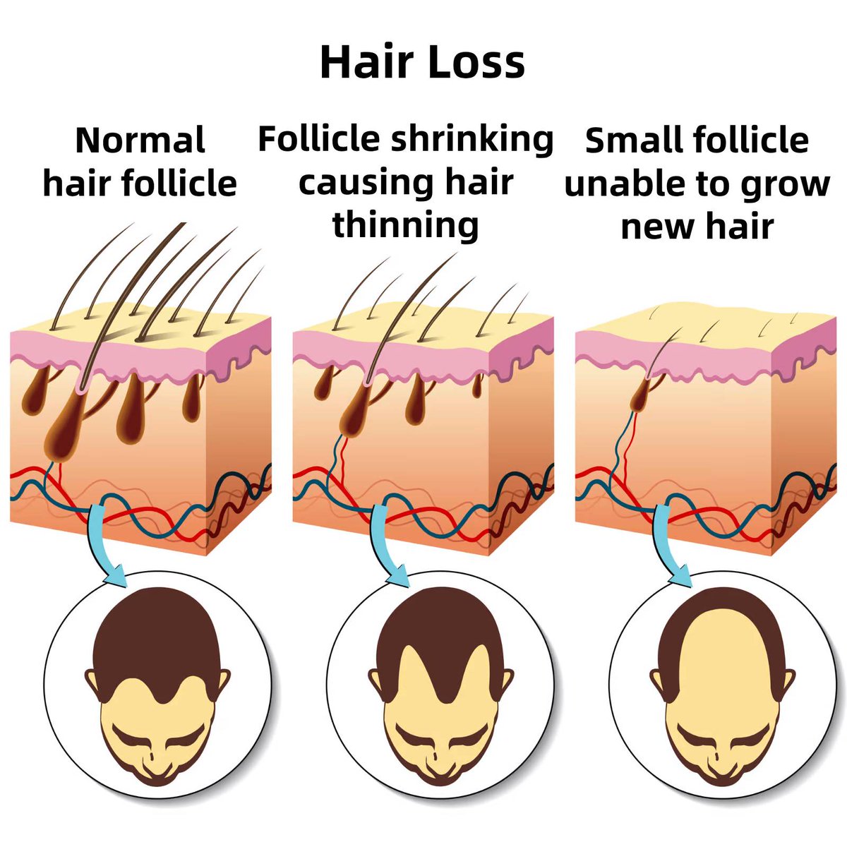 iHelmetshop's tweet photo. 𝑺𝒉𝒓𝒊𝒏𝒌𝒊𝒏𝒈 – These produce thinner hairs and may stop growing hair altogether. They can be revived with LLLT, Minoxidil, or Finasteride.
𝑫𝒆𝒂𝒅 – If severely damaged, they won’t regrow hair without surgical options like a hair transplant. https://t.co/el8L5t3qrT